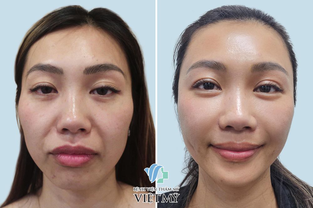 Hình ảnh trước và sau khách hàng làm đầy thái dương, rãnh mũi má bằng mỡ tự thân
