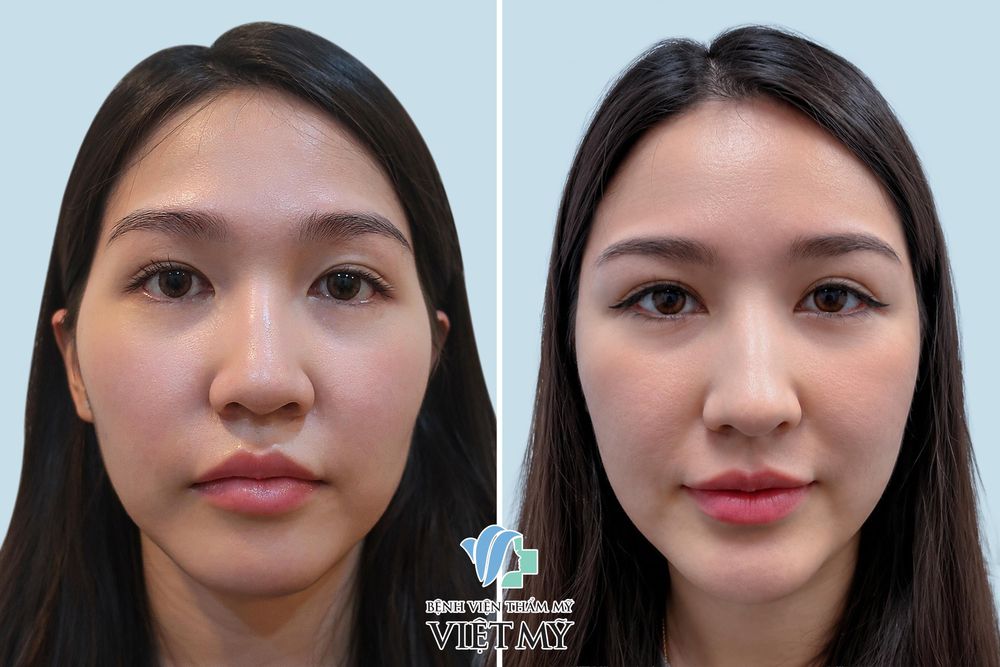 Hình ảnh trước và sau khách hàng làm đầy thái dương bằng mỡ tự thân