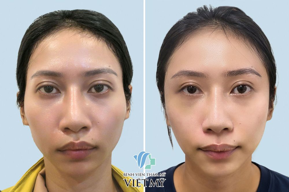 Hình ảnh trước và sau khách hàng độn thái dương bằng vật liệu nhân tạo