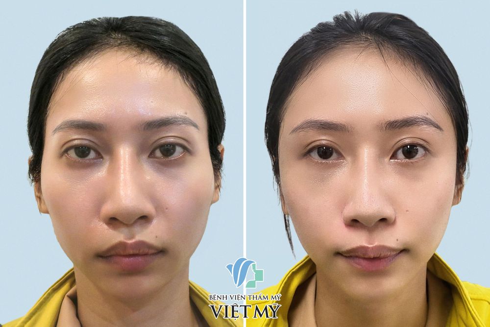 Hình ảnh trước và sau khách hàng làm đầy thái dương và độn thái dương bằng mỡ tự thân