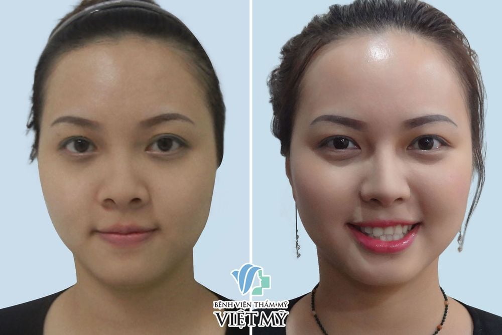 Hình ảnh khách hàng trước và sau thu gọn cánh mũi, nâng mũi