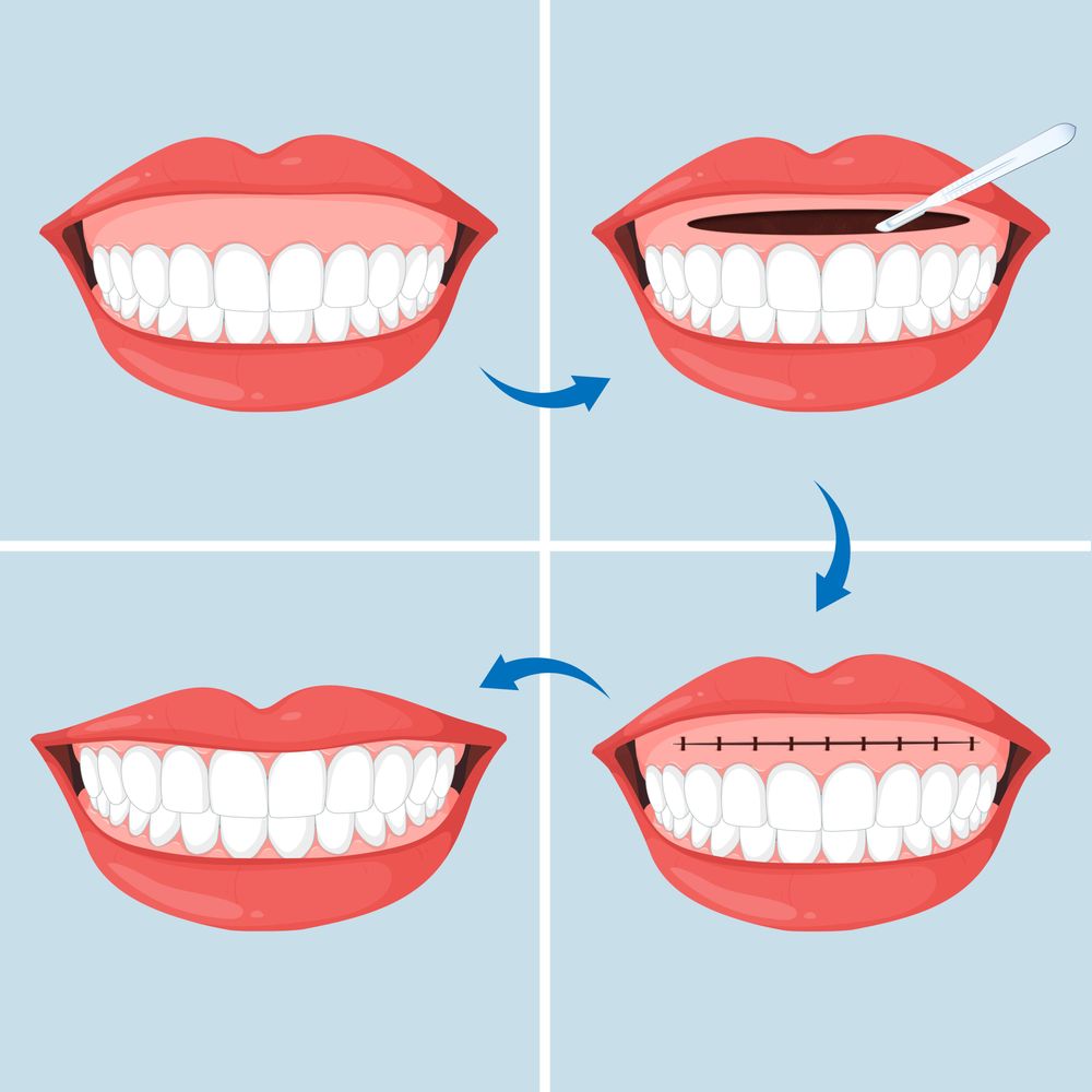 Hình minh họa phẫu thuật kéo dài môi trên