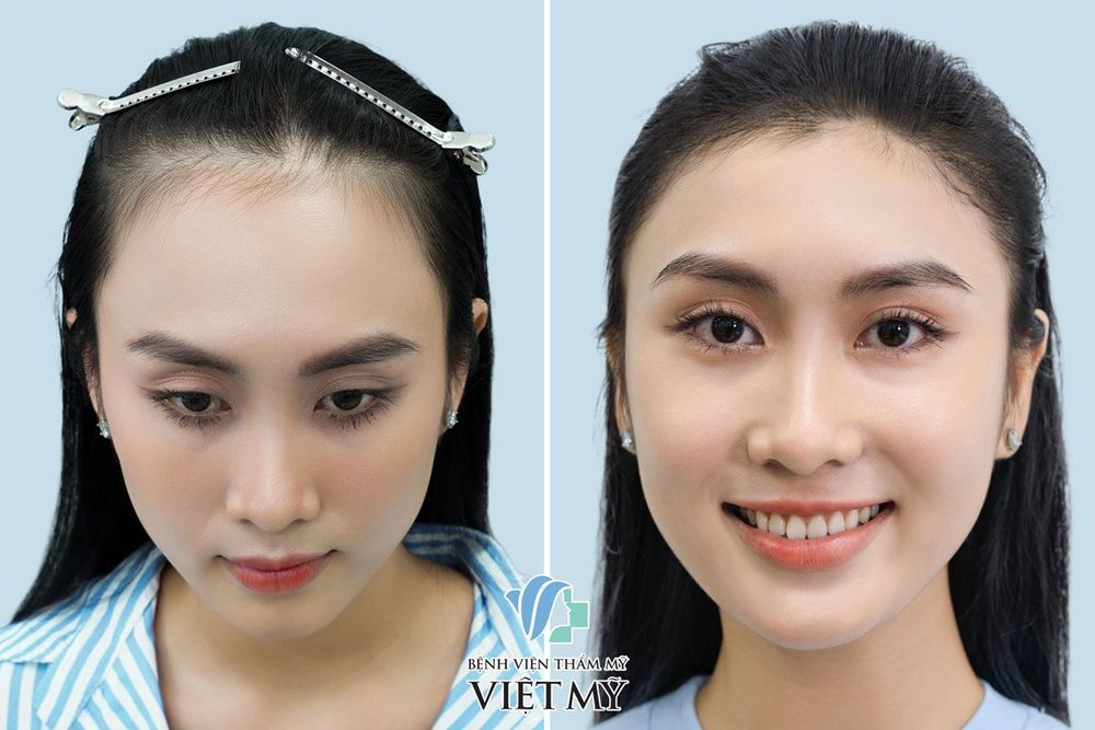 Hình ảnh khách hàng nữ trước và sau 7 tháng cấy tóc