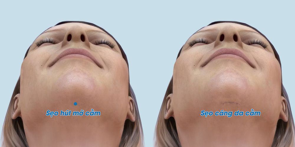 Đường mổ phẫu thuật căng da cằm