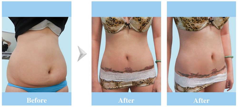 Image of a client before and after undergoing liposuction and tummy tuck