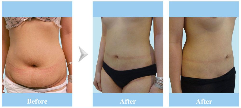 A client before and after liposuction and abdominoplasty
