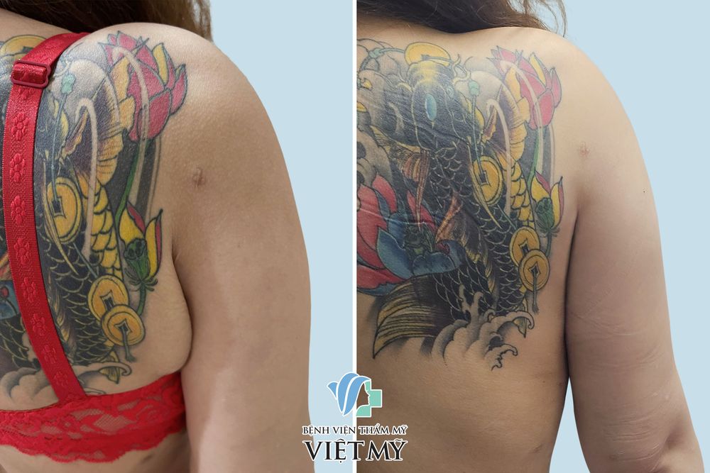 Hình ảnh trước và sau khi khách hàng hút mỡ, căng da tay, nách.