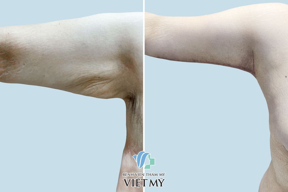 Hút mỡ, căng da tay nách phải