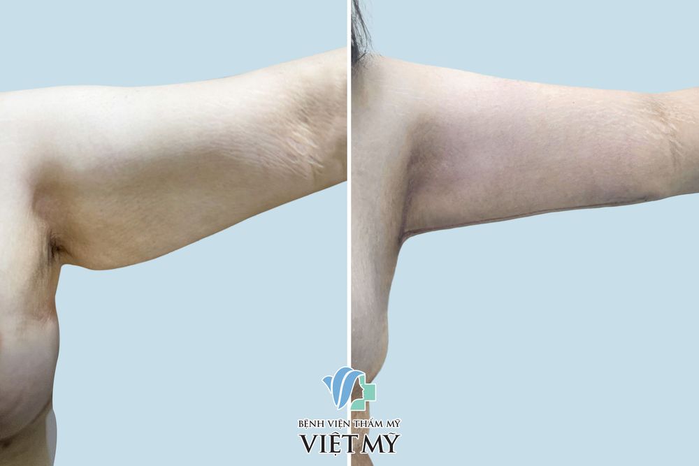 hút mỡ, căng da tay nách trái