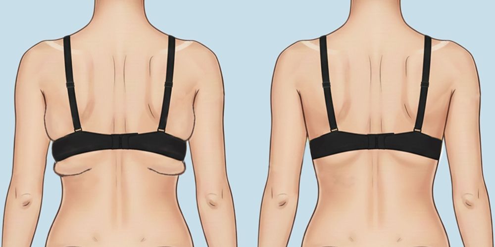 Mô phỏng lợi ích của phẫu thuật hút mỡ lưng, nách
