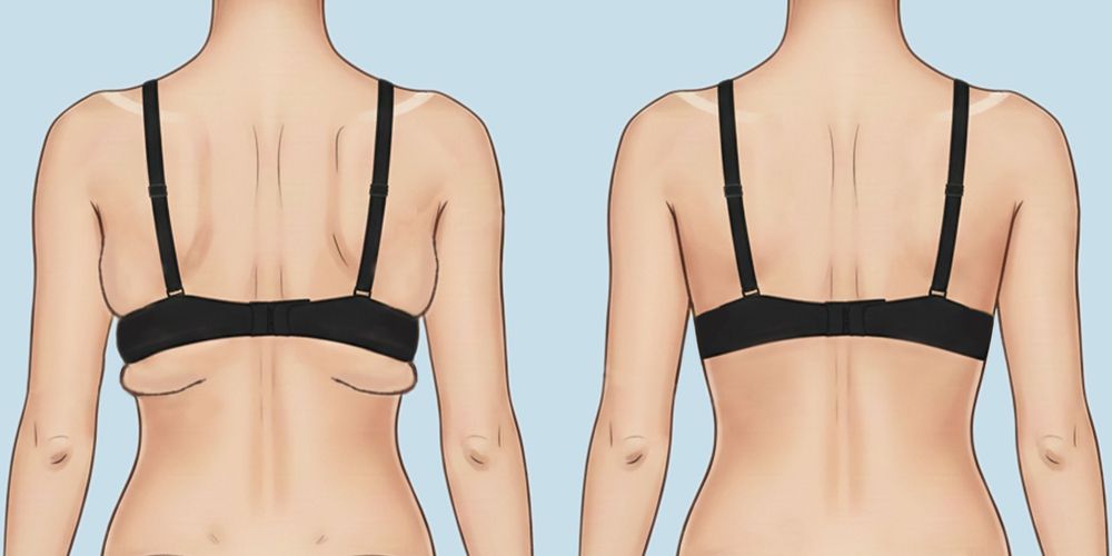 Mô phỏng lợi ích của phẫu thuật hút mỡ lưng, nách
