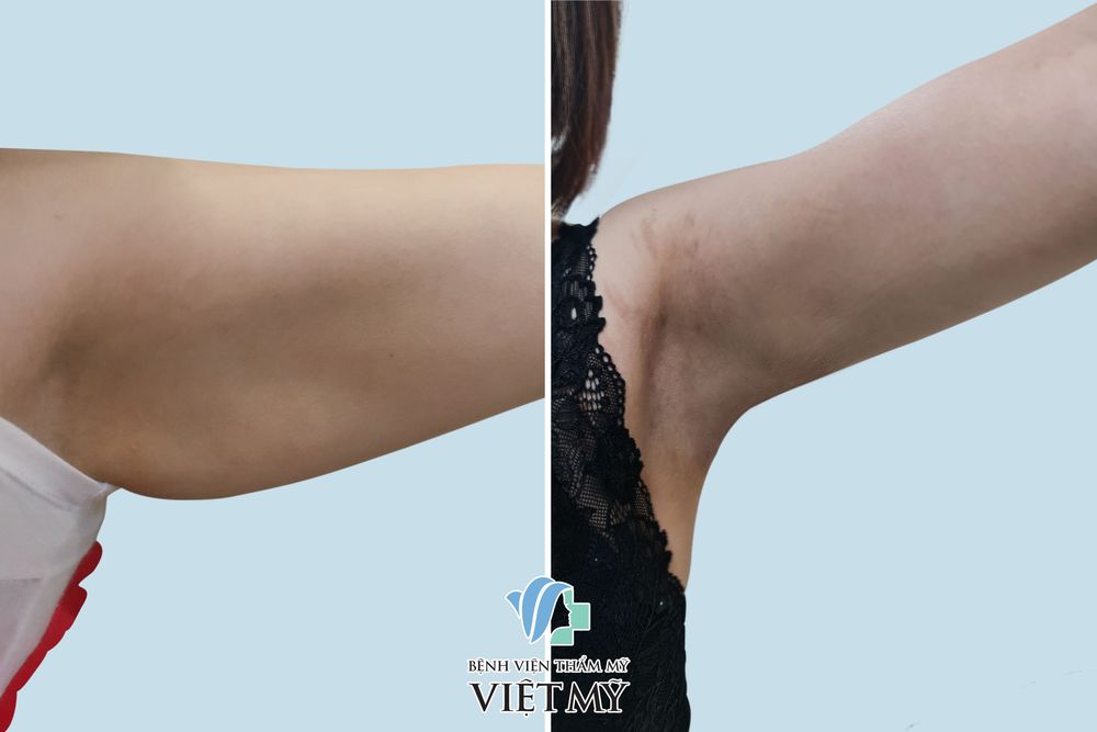 Hình ảnh trước và sau khi khách hàng hút mỡ tay, nách