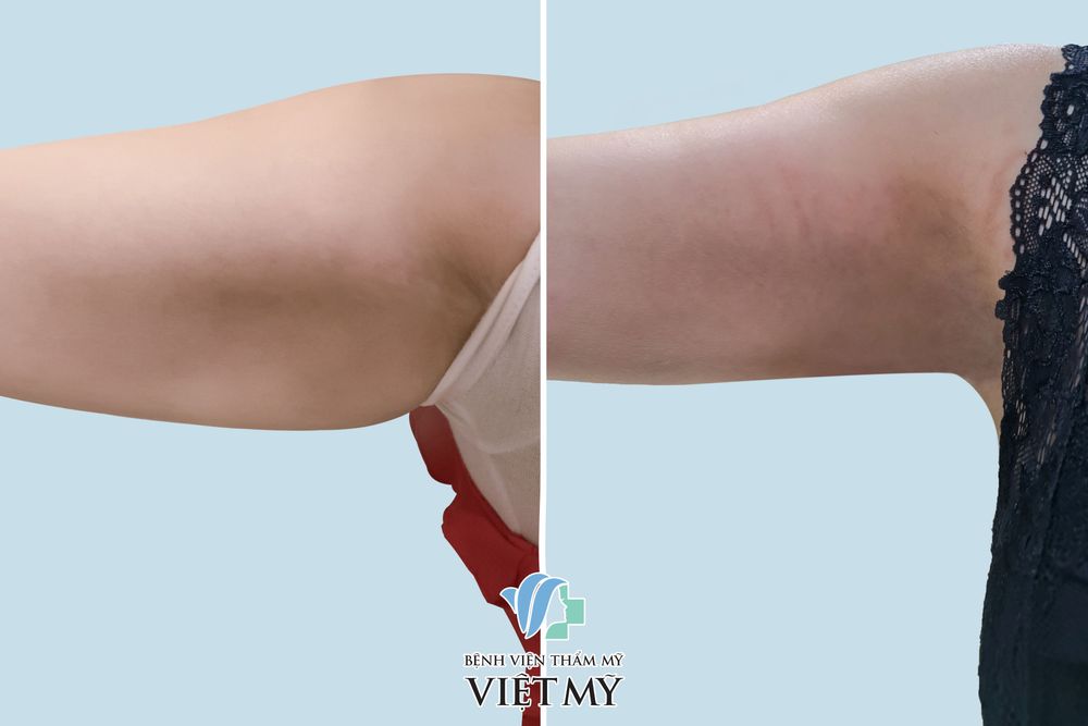 Hình ảnh trước và sau khi khách hàng hút mỡ tay, nách