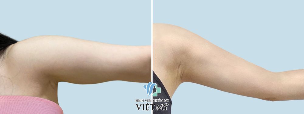 khách hàng hút mỡ tay trái