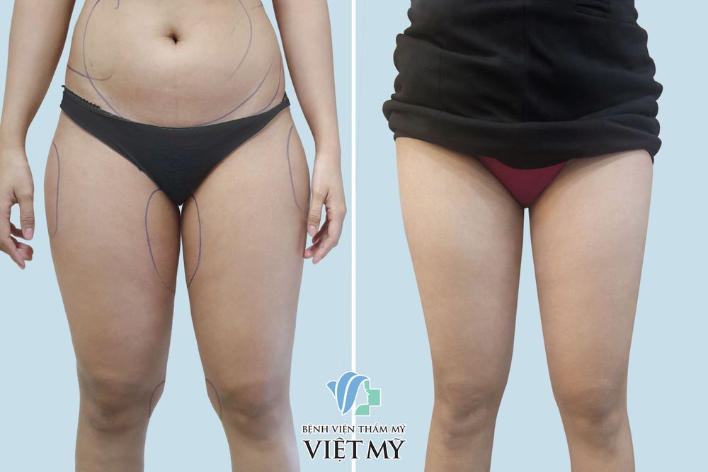 khách hàng hút mỡ bụng, đùi
