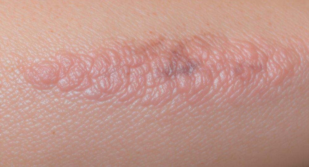 Nâng ngực có để lại sẹo không sẽ tùy vào cơ địa tay nghề bác sĩ thẩm mỹ và cách chăm sóc hậu phẫu thuật. 