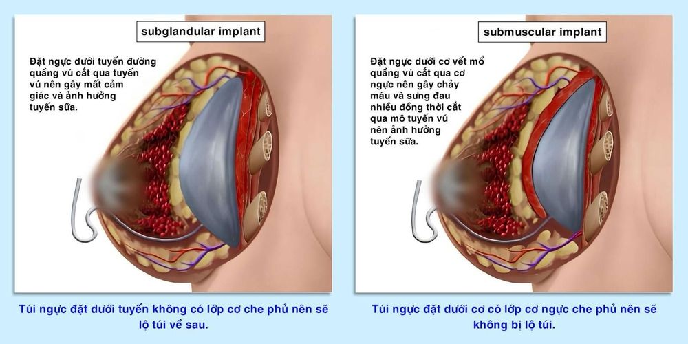 Túi độn được đưa vào vị trí thích hợp và điều chỉnh cân đối.