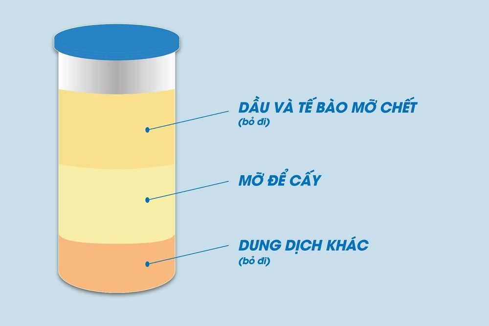 Mô mỡ sẽ được hút ra, tinh lọc để chọn lựa những tế bào mỡ khỏe mạnh, có thể sống sót sau khi cấy vào ngực. 

