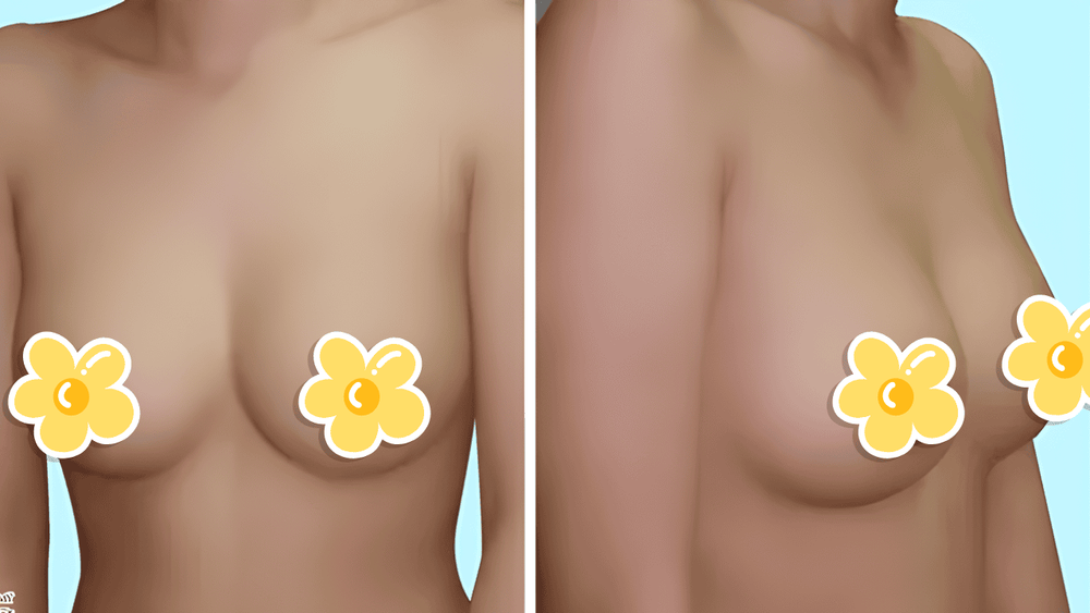 Lõm ngực từ nhỏ có thể nâng ngực không phụ thuộc vào mức độ lõm ở vùng ngực.