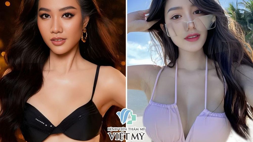 Hình ảnh trước và sau khi nâng ngực Mentor của Tuyết Nguyễn - Top 5 hoa hậu Việt Nam