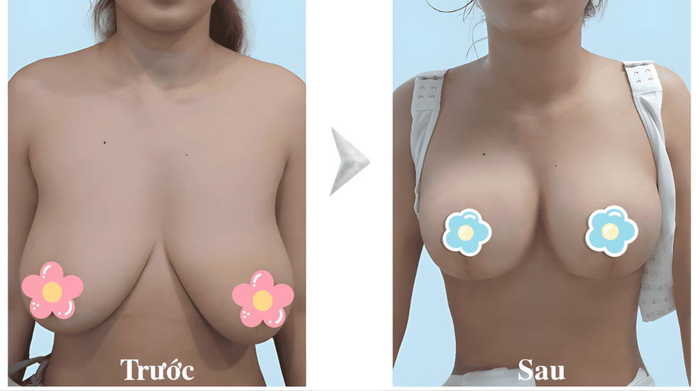 Thay đổi hormone trong thời kỳ mang thai và cho con bú dễ gây ra tình trạng ngực bên to bên nhỏ.