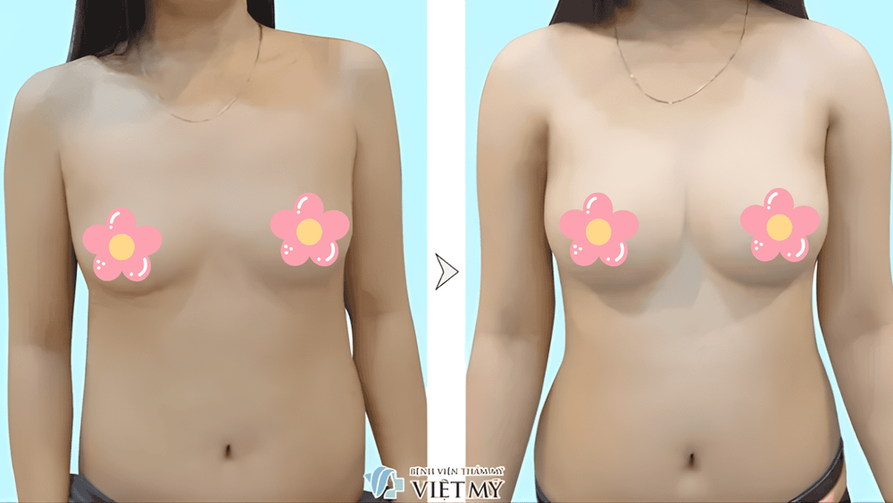 Nâng ngực bằng mỡ tự thân mang lại bầu ngực căng tròn, mềm mại và tự nhiên như thật 