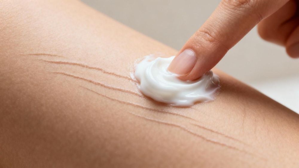 Sử dụng các loại kem bôi, serum, vitamin có thể góp phần làm mờ vết rạn, tuy nhiên hiệu quả không đáng kể bằng các kỹ thuật xâm lấn. 