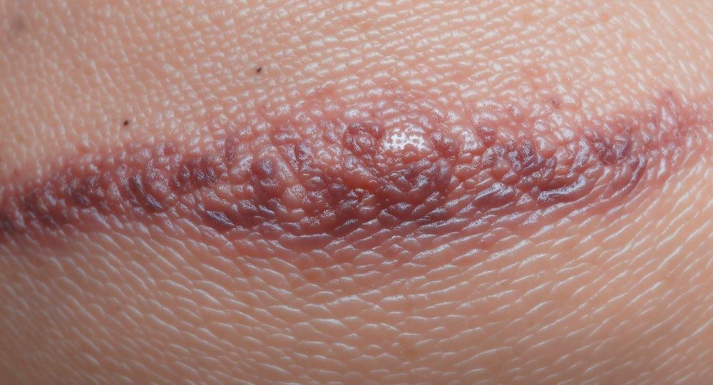 Sẹo thâm sau nâng ngực hình thành do sắc tố melanin tăng sinh