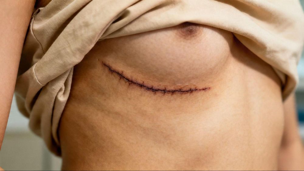 Bạn nên bôi thuốc trị sẹo sau phẫu thuật nâng ngực khi vết thương đã đóng miệng.
