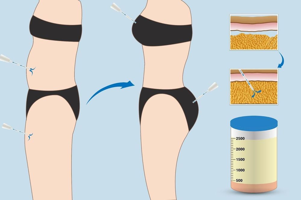 Mỡ sẽ được lấy ở những vùng bụng, đùi, bắp tay, mông và cấy vào vùng ngực. 
