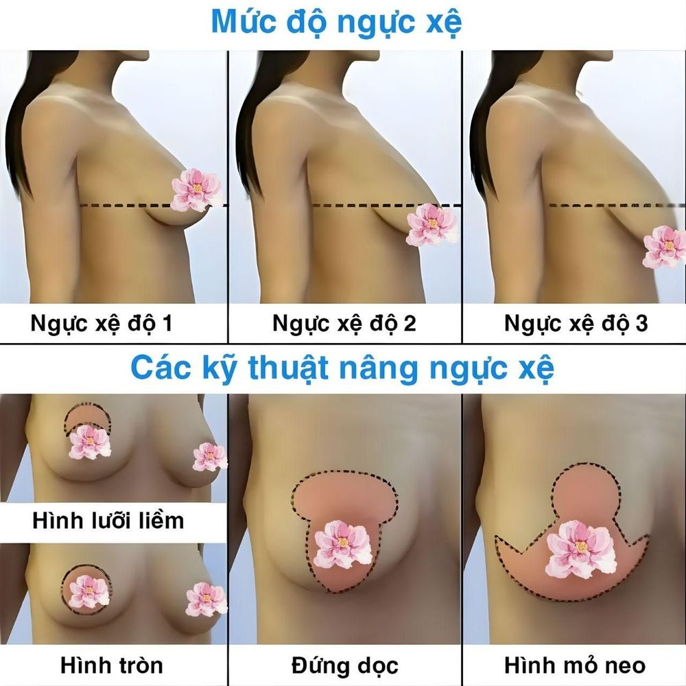 Bác sĩ thẩm mỹ sẽ ứng dụng các kỹ thuật nâng ngực sa trễ khác nhau tùy vào mức độ chảy xệ