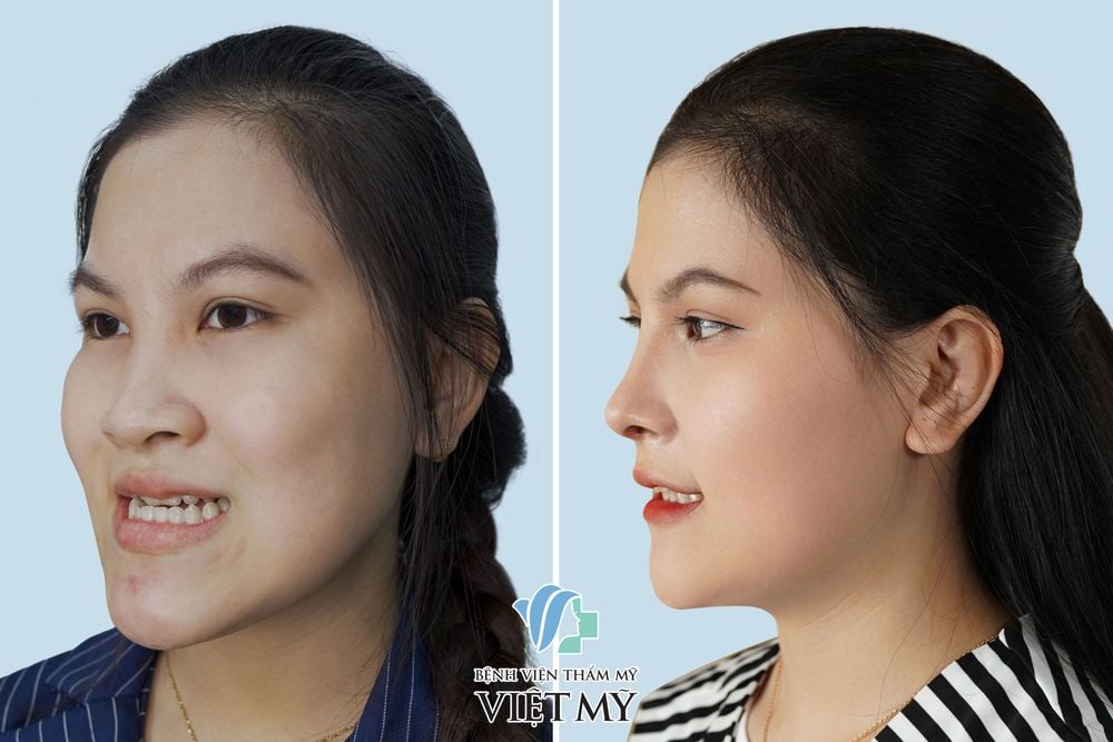 Độn Cằm Hàn Quốc V Line - nâng cằm - bác sĩ Chiêm Quốc Thái