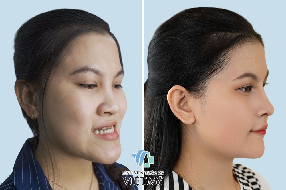 Khách hàng trước và sau trượt cằm, tạo hình hàm móm
