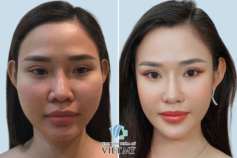 Khách hàng trước và sau nâng mũi, nâng cằm, hạ gò má