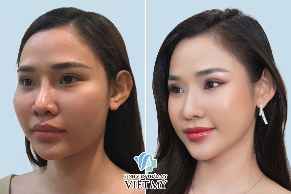 Hạ thấp gò má - Bác Sĩ Chiêm Quốc Thái