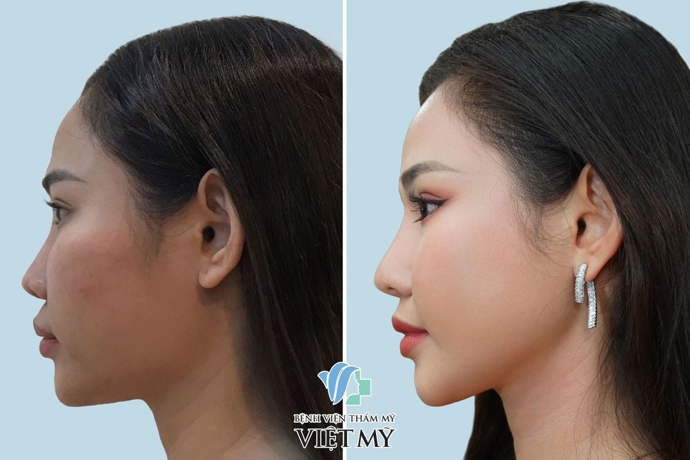 Khách hàng trước và sau hạ gò má, nâng mũi, nâng cằm.