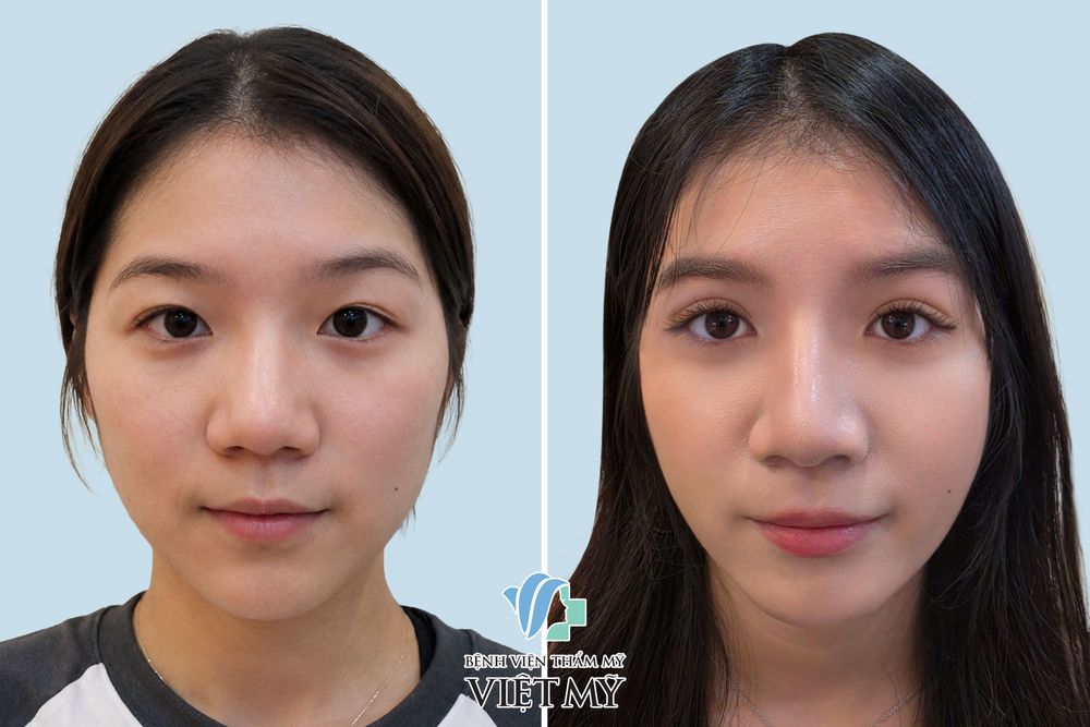Khách hàng mí mắt không đều, nếp rẻ quạt ở khóe mắt trong đã thực hiện cắt mắt, mở rộng góc mắt trong