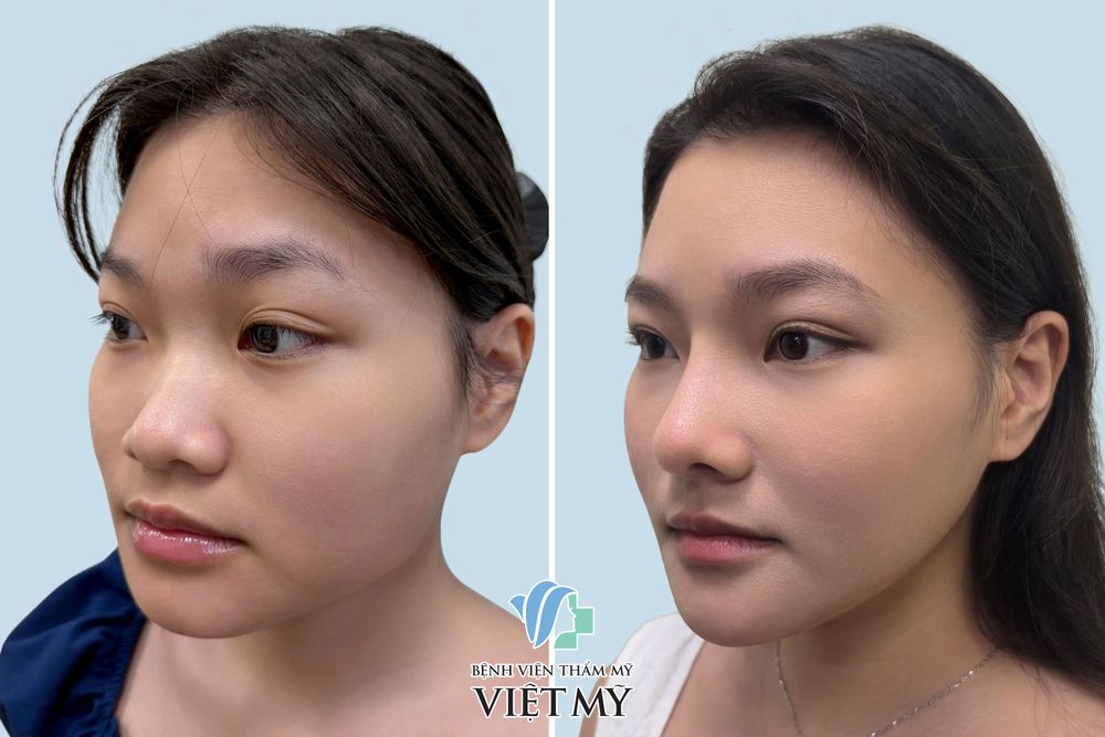 Khách hàng mũi thấp, góc hàm lớn, cằm vẩu ngắn đã thực hiện nâng mũi cấu trúc, gọt góc hàm, trượt cằm