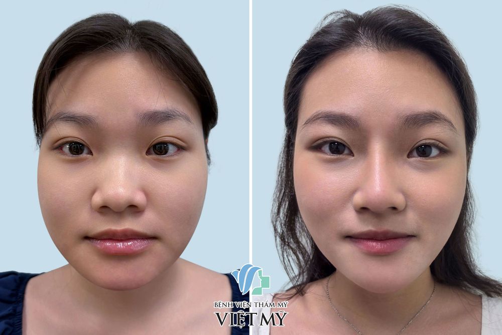 Khách hàng mũi thấp, góc hàm lớn, cằm vẩu ngắn đã thực hiện nâng mũi cấu trúc, gọt góc hàm, trượt cằm