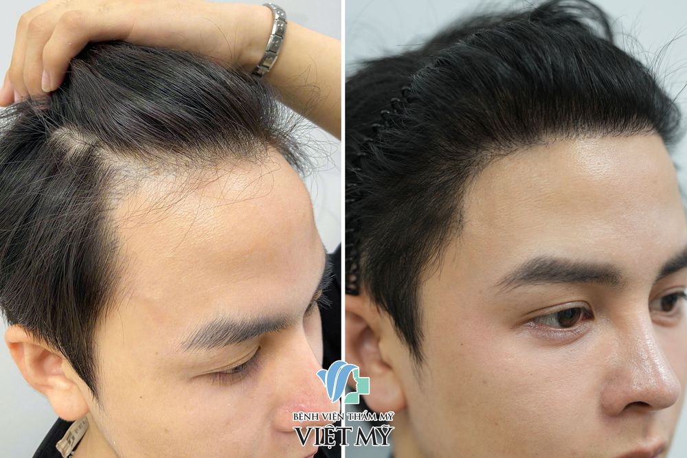 Cấy tóc DHI (FUE)  – Cấy tóc trực tiếp