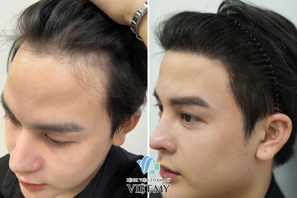 Hình ảnh khách hàng nam trước và sau 1 năm cấy tóc
