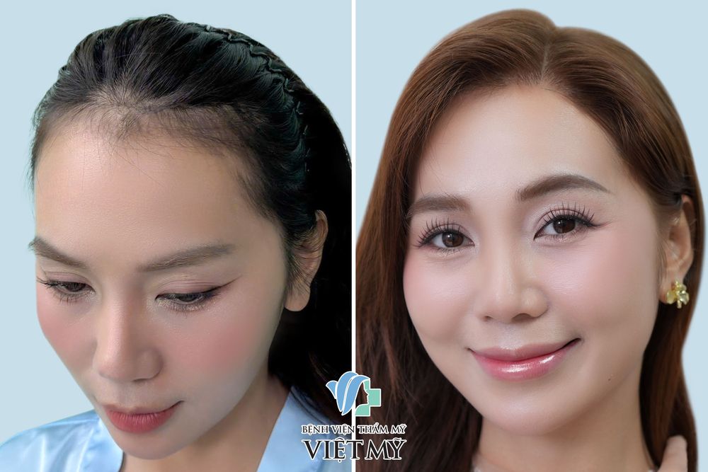 Hình ảnh khách hàng nữ trước và sau 1 năm cấy tóc