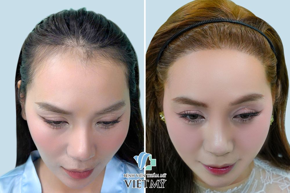 Cấy tóc DHI (FUE)  – Cấy tóc trực tiếp