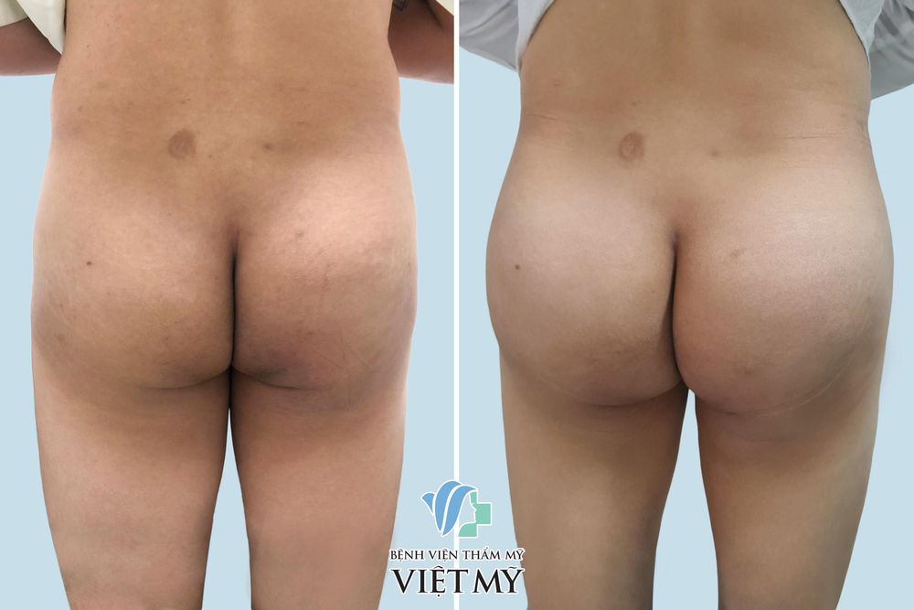 Khách hàng nam trước  và sau nâng mông nội soi