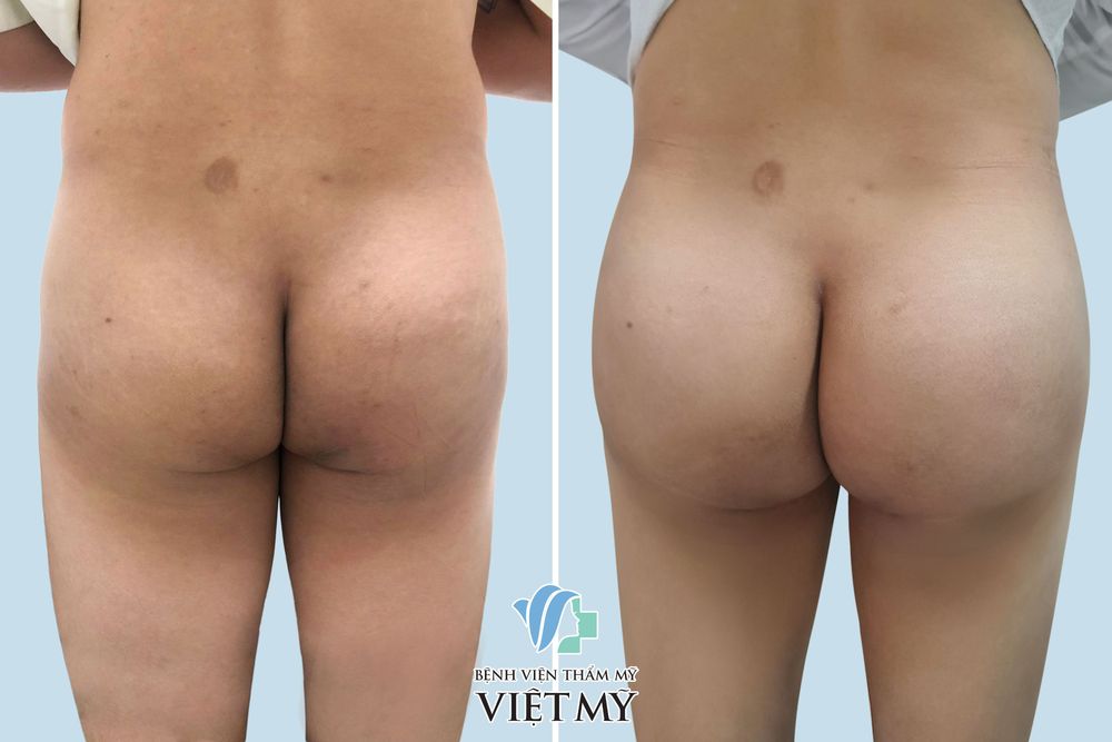Khách hàng nam trước  và sau nâng mông nội soi