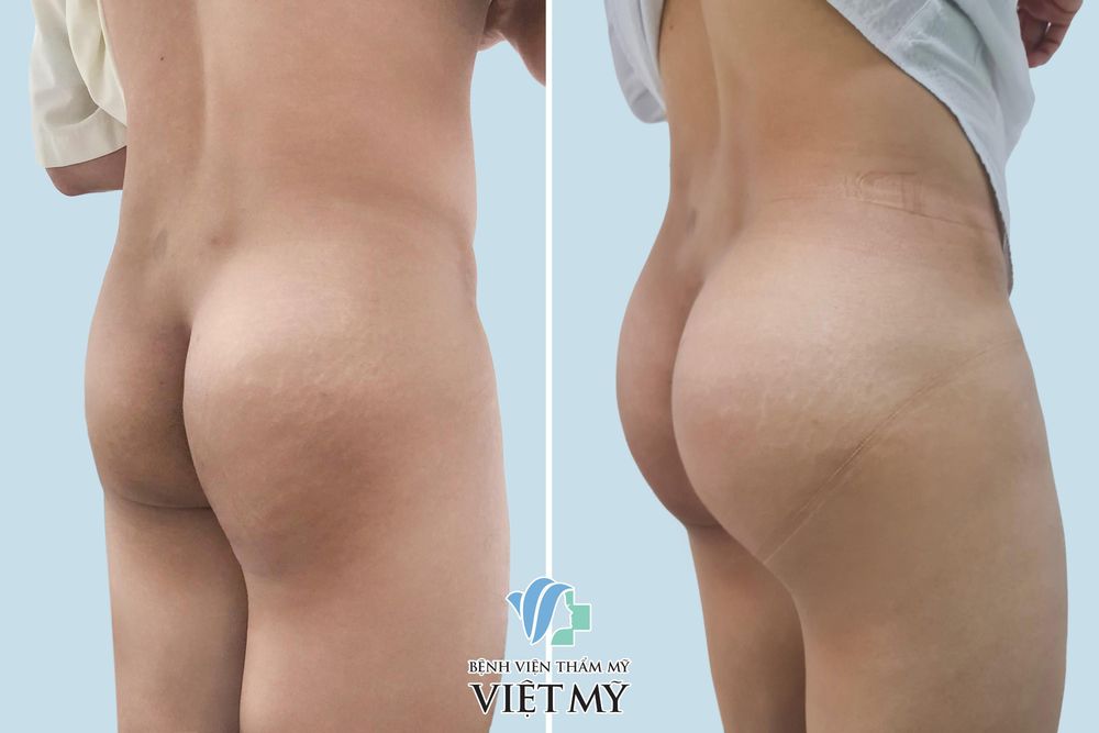 Nâng Mông Nội Soi - Độn Mông Nội Soi - bác sĩ Chiêm Quốc Thái