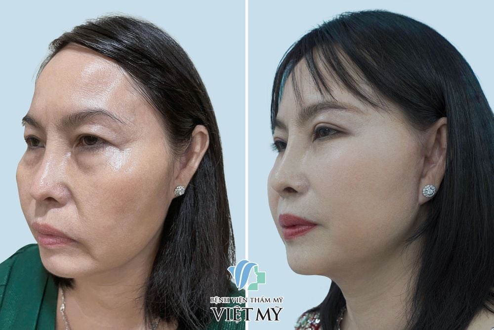 Căng da mặt nội soi - Bác sĩ Chiêm Quốc Thái