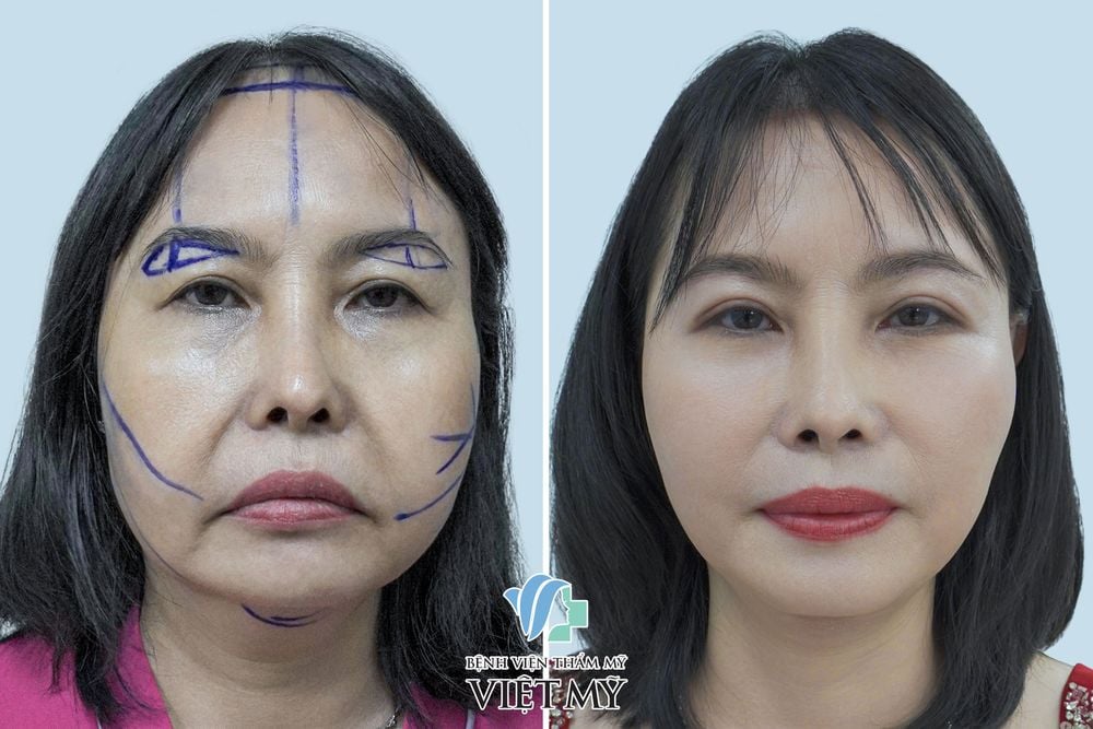 Khách hàng U60 căng da mặt nội soi, treo chân mày, cắt mí dưới, hạ đường chân tóc.