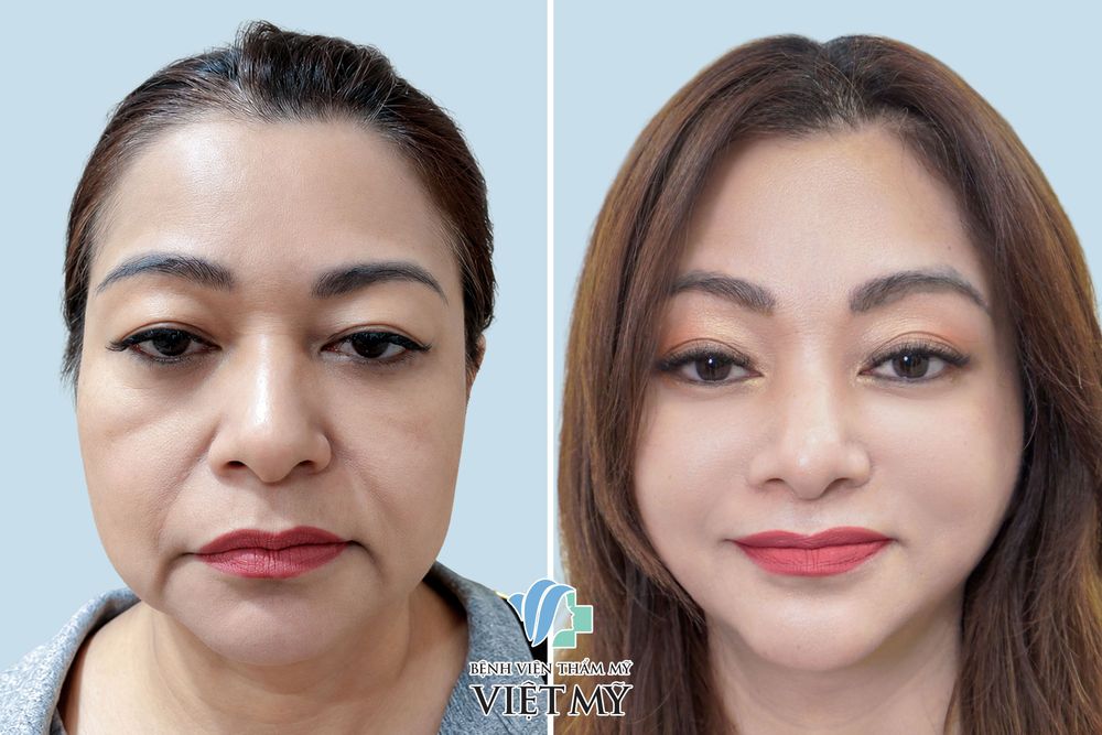 Khách hàng trước và sau căng da trán nội soi, căng da mặt nội soi