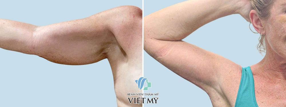 Hình ảnh trước và sau khi khách hàng căng da tay